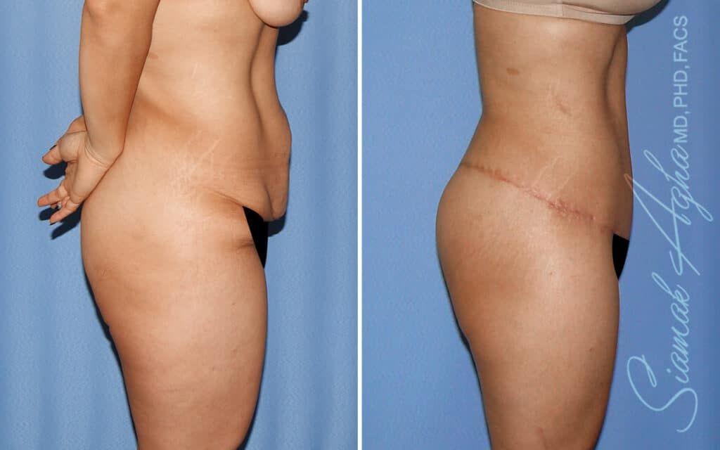 Lower Body Lift Before & After