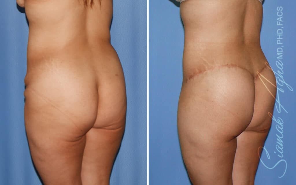 Lower Body Lift Before & After