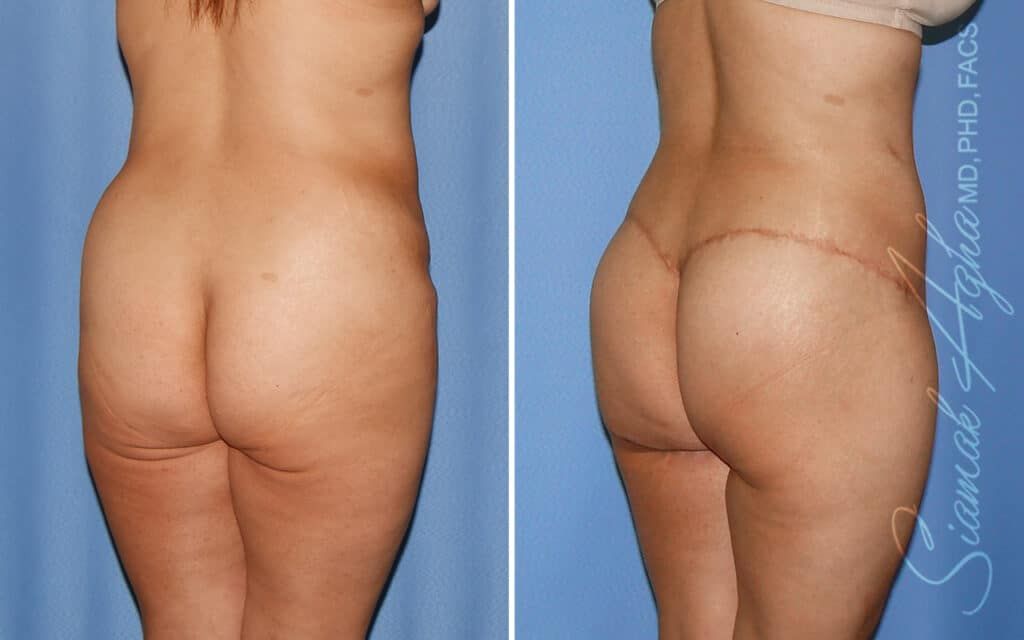 Lower Body Lift Before & After