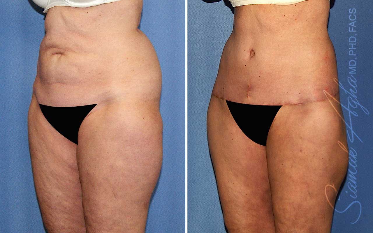 Lower Body Lift Before & After