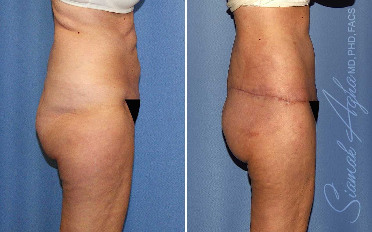 Lower Body Lift Before & After