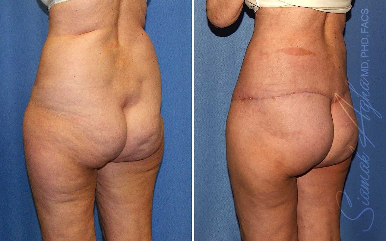 Lower Body Lift Before & After