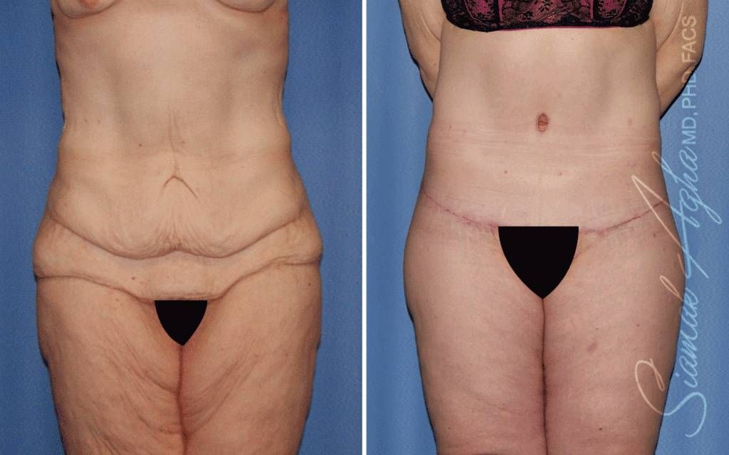 Lower Body Lift Before & After