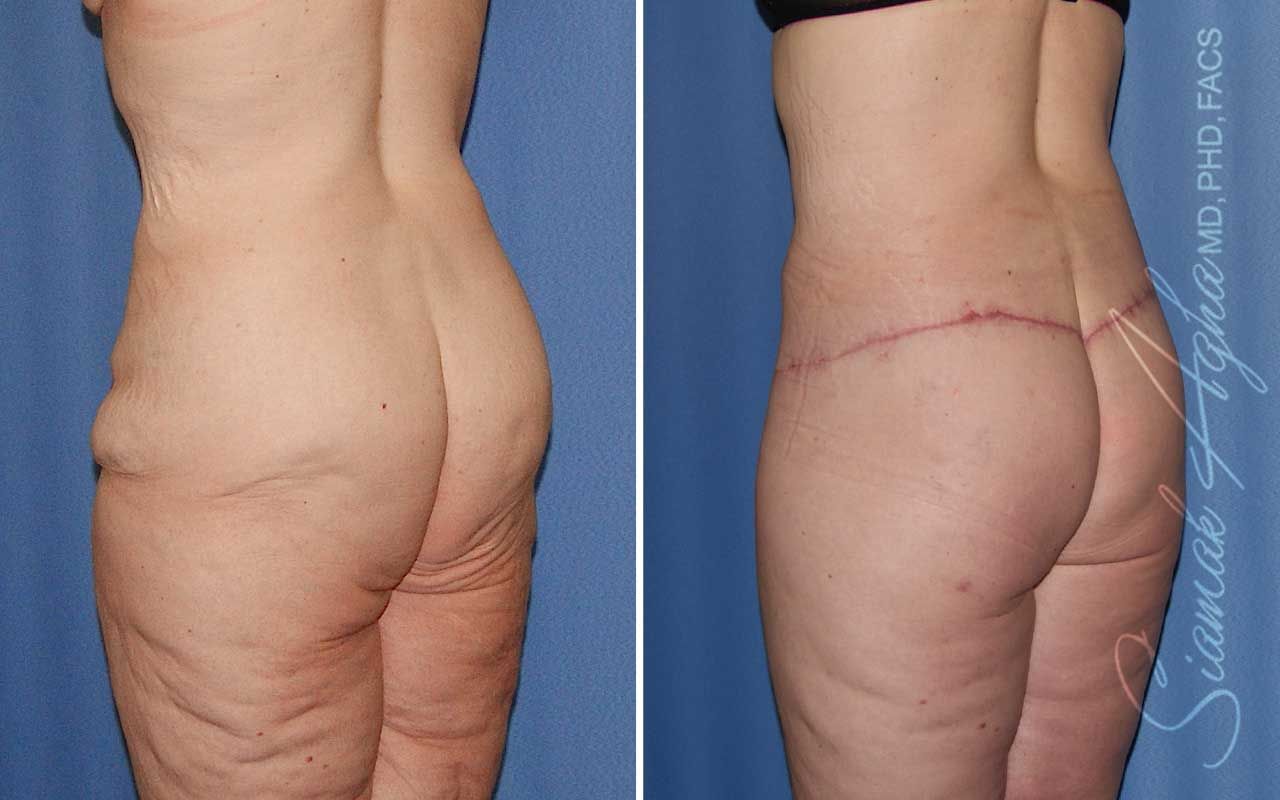 Lower Body Lift Before & After