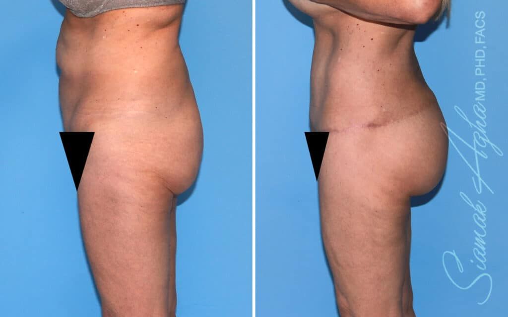 Lower Body Lift Before & After