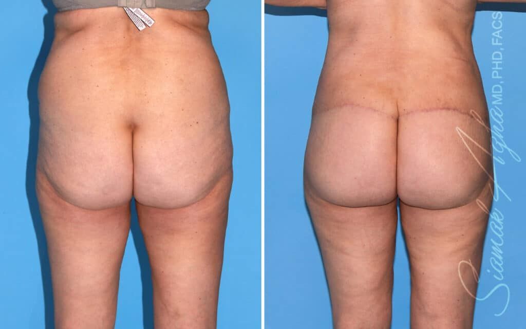 Lower Body Lift Before & After