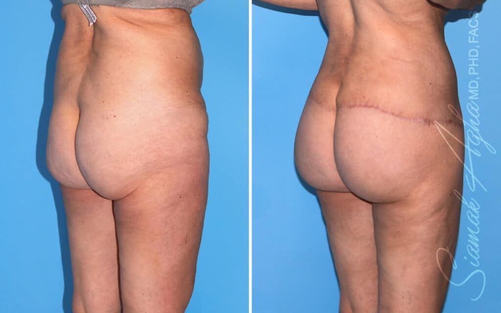 Lower Body Lift Before & After