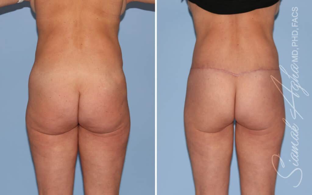 Lower Body Lift Before & After