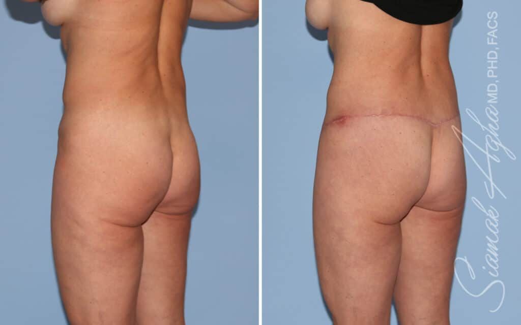 Lower Body Lift Before & After