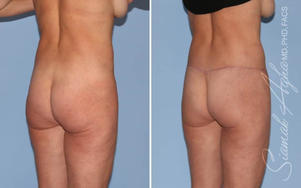 Lower Body Lift Before & After