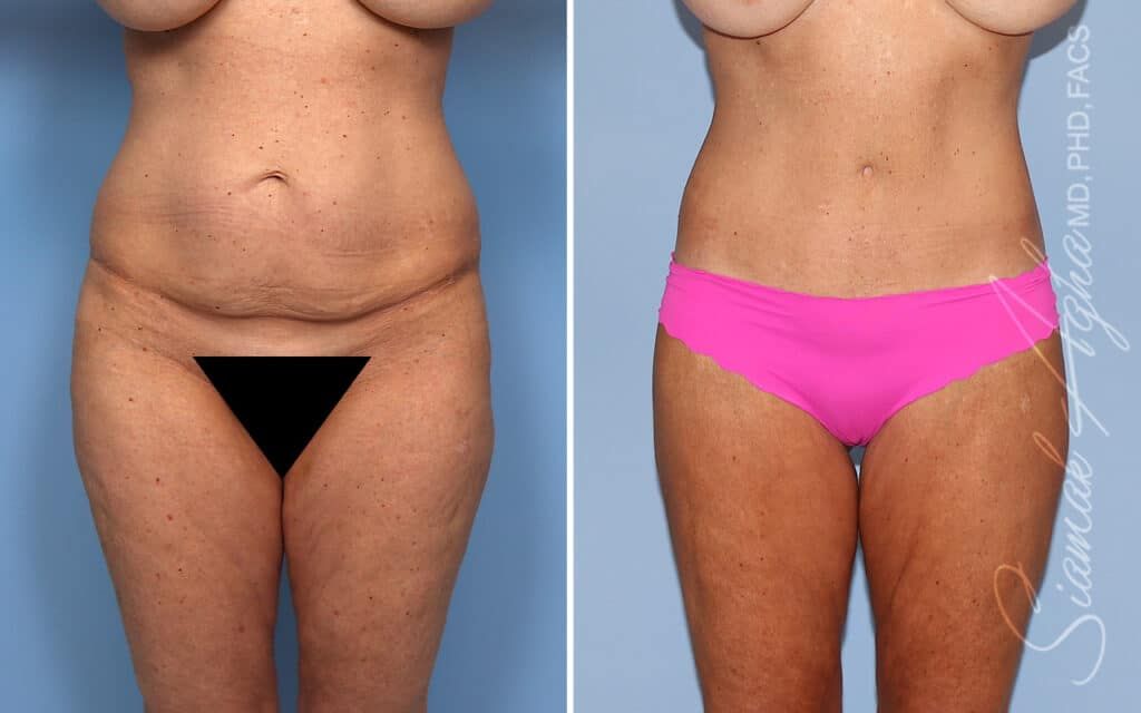 Lower Body Lift Before & After