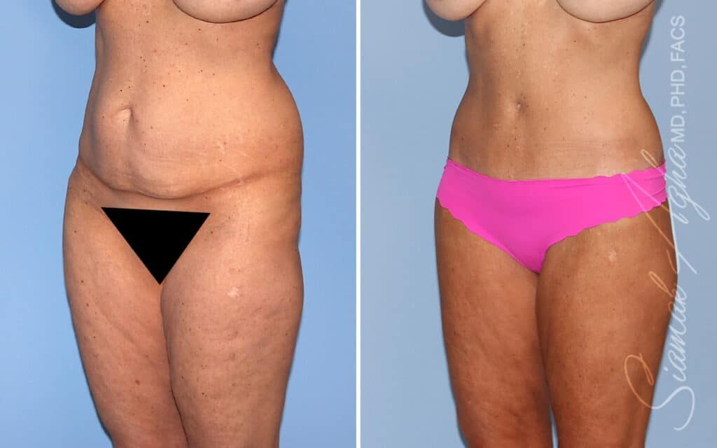 Lower Body Lift Before & After