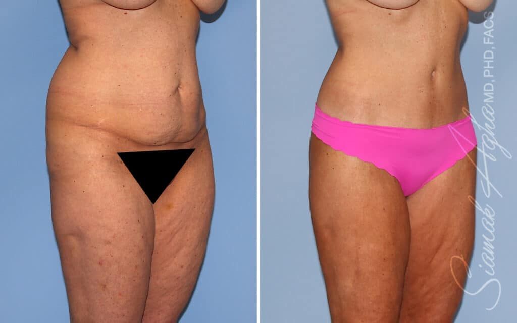 Lower Body Lift Before & After