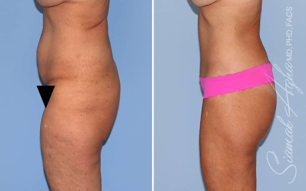 Lower Body Lift Before & After
