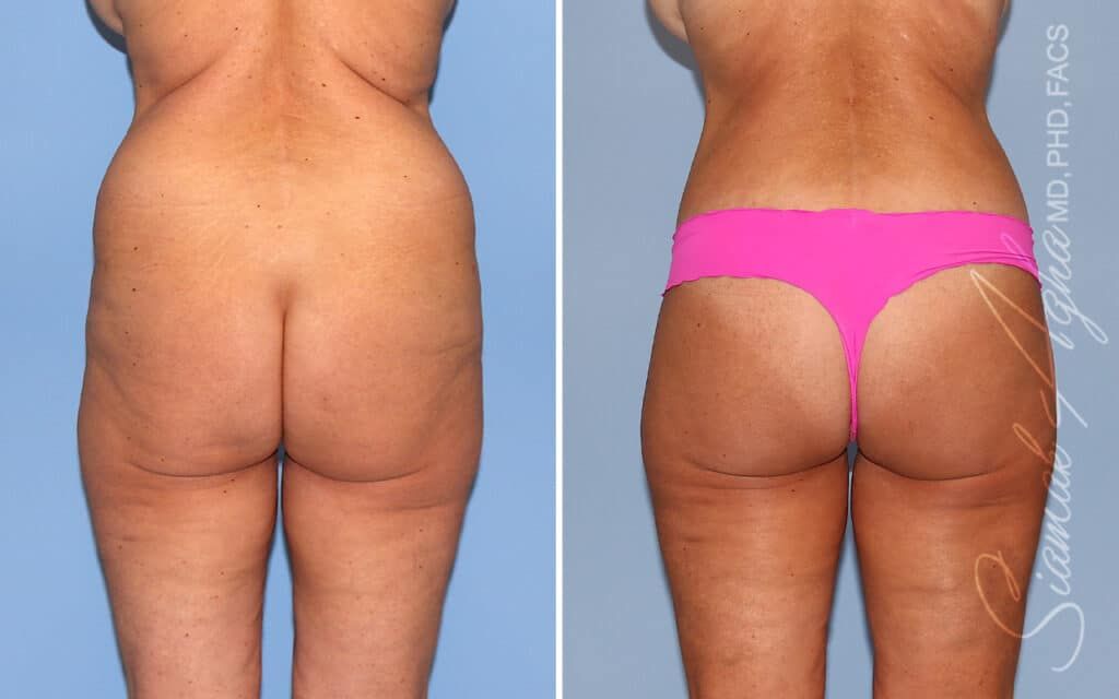 Lower Body Lift Before & After