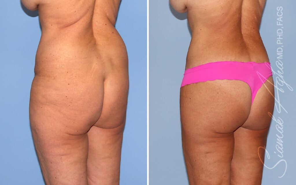 Lower Body Lift Before & After