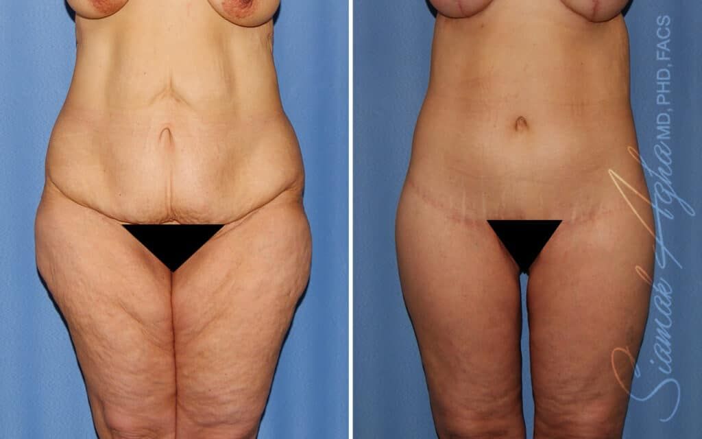 Lower Body Lift Before & After