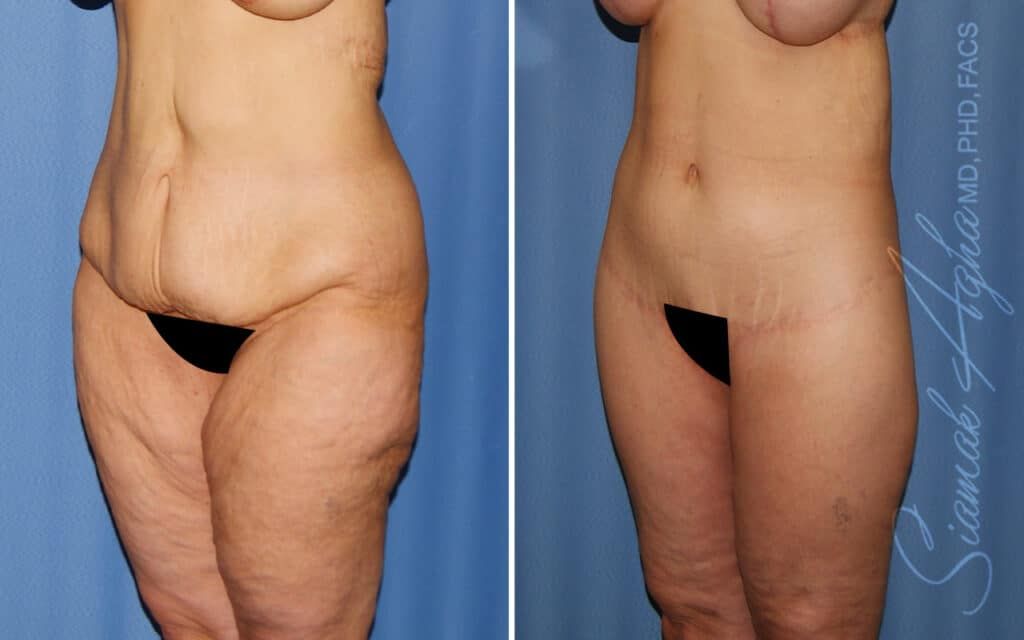 Lower Body Lift Before & After