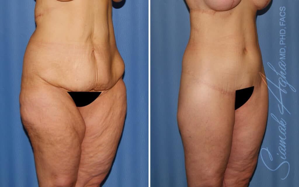 Lower Body Lift Before & After