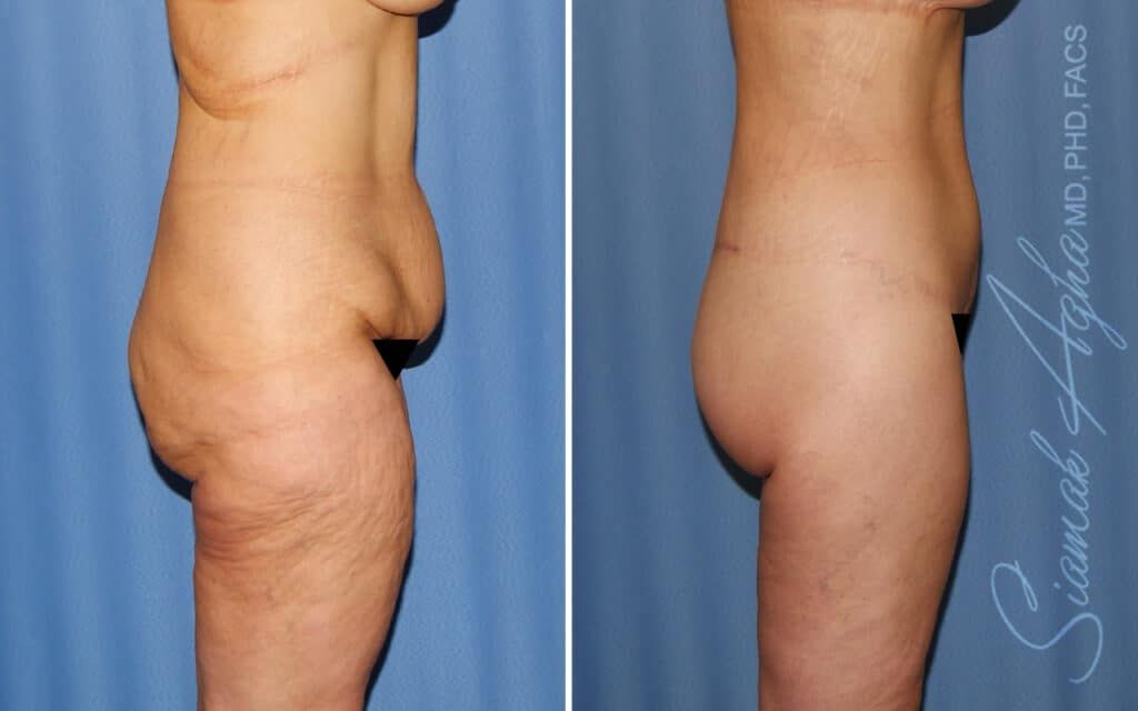Lower Body Lift Before & After