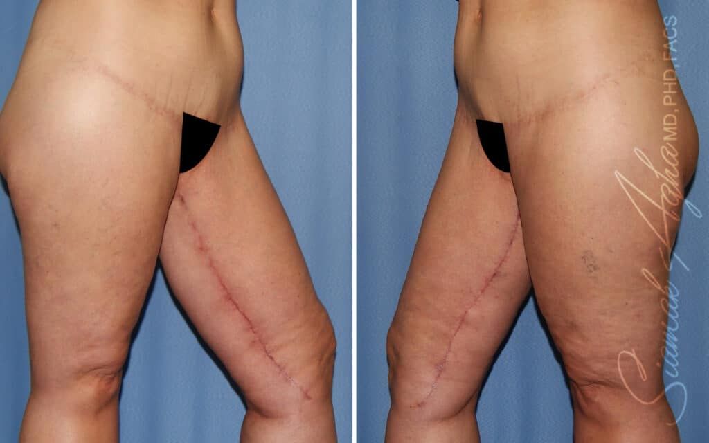 Lower Body Lift Before & After