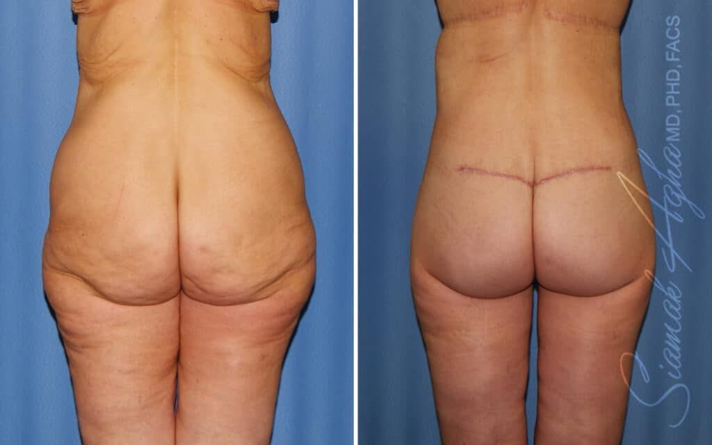 Lower Body Lift Before & After
