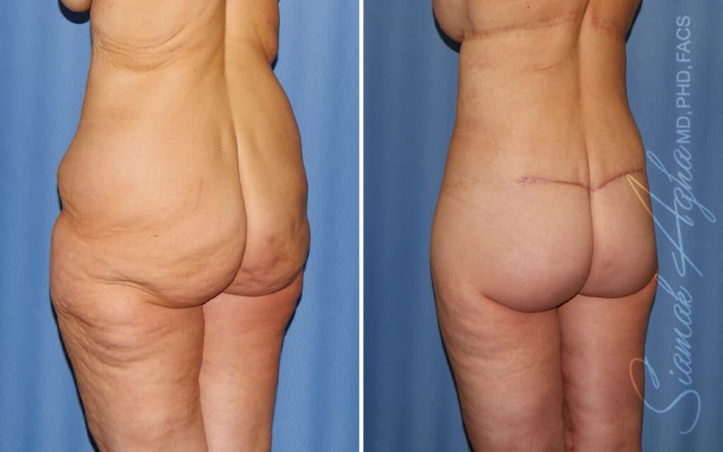 Lower Body Lift Before & After
