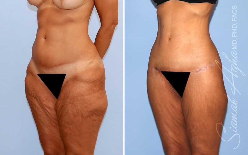 Lower Body Lift Before & After