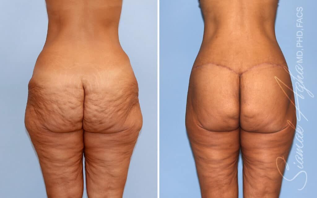 Lower Body Lift Before & After