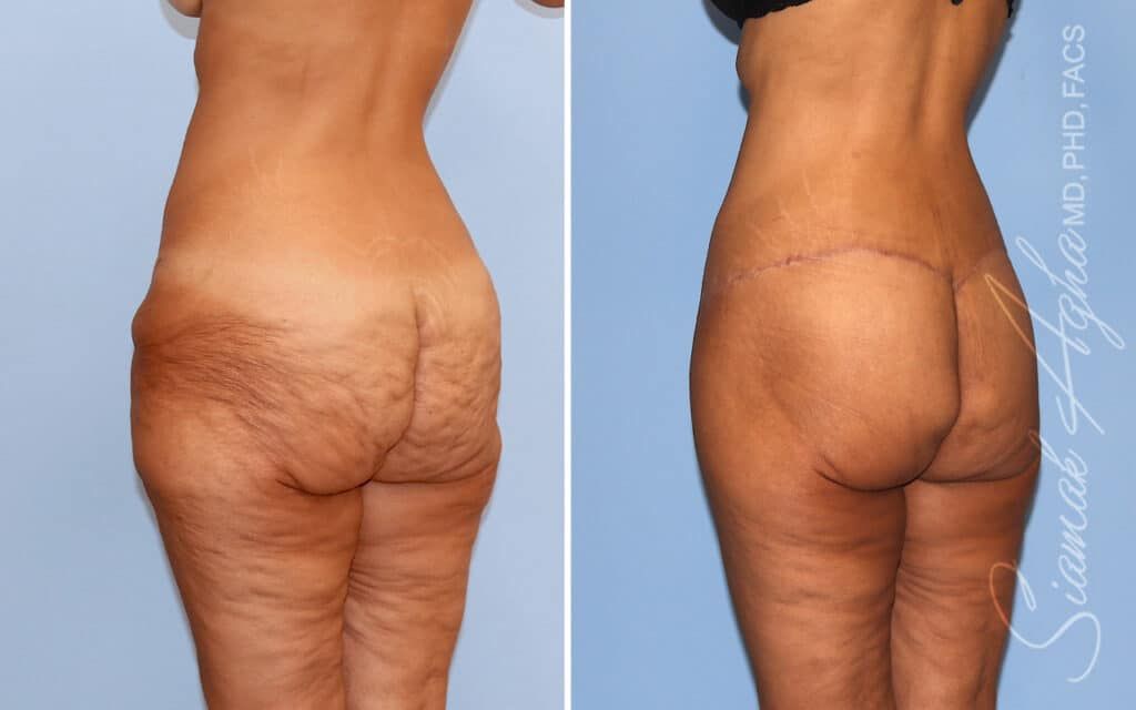 Lower Body Lift Before & After