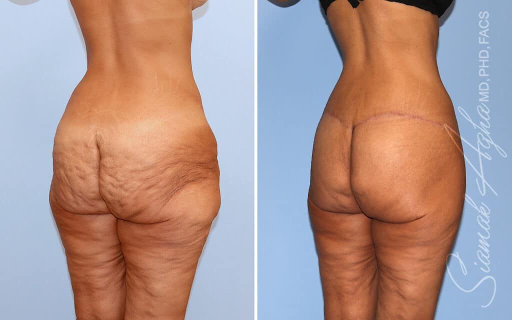 Lower Body Lift Before & After