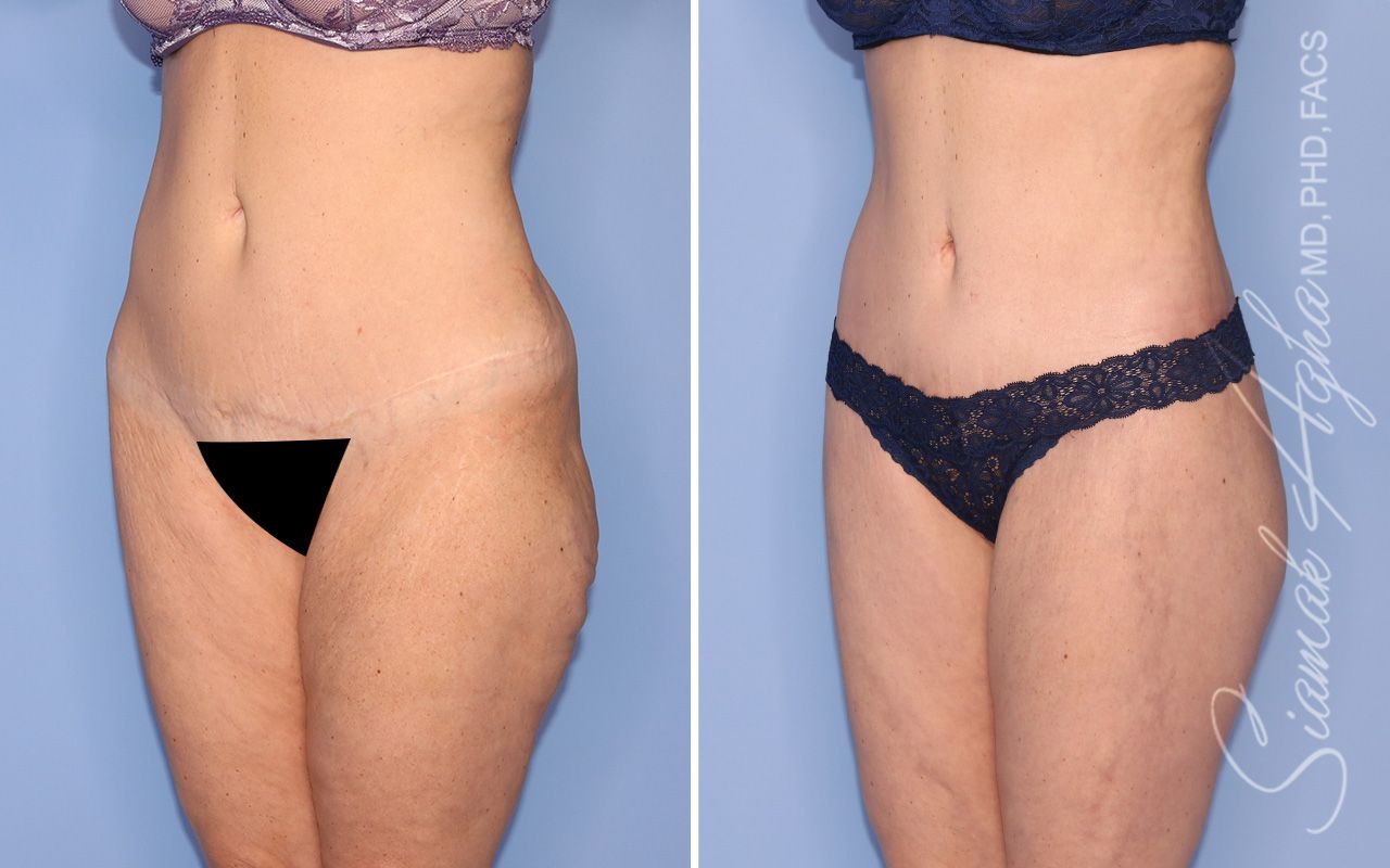 Lower Body Lift Before & After