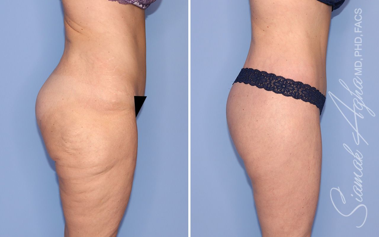 Lower Body Lift Before & After