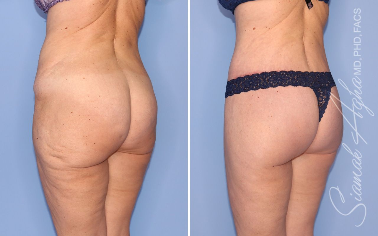 Lower Body Lift Before & After