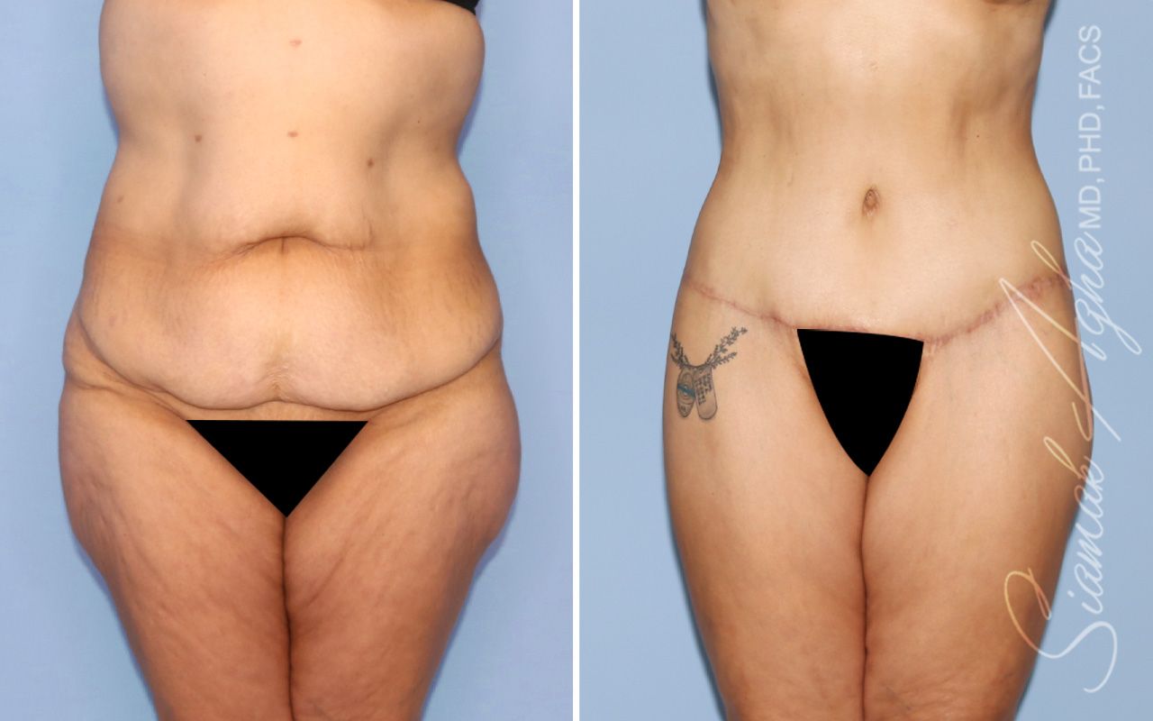 Lower Body Lift Before & After