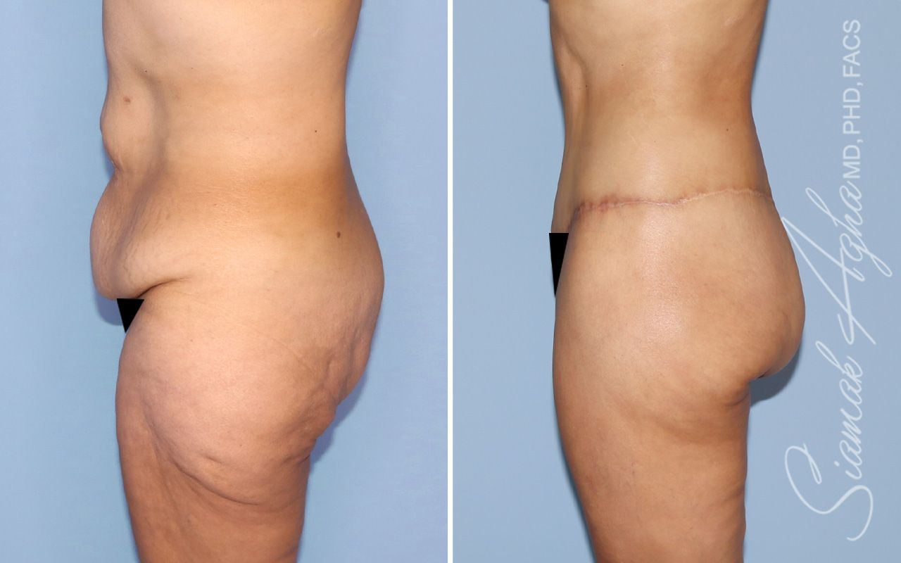 Lower Body Lift Before & After