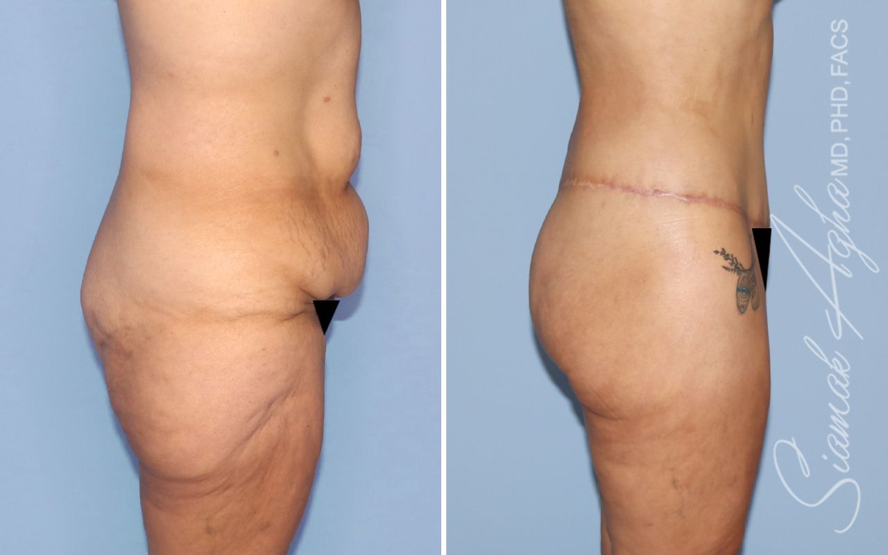 Lower Body Lift Before & After