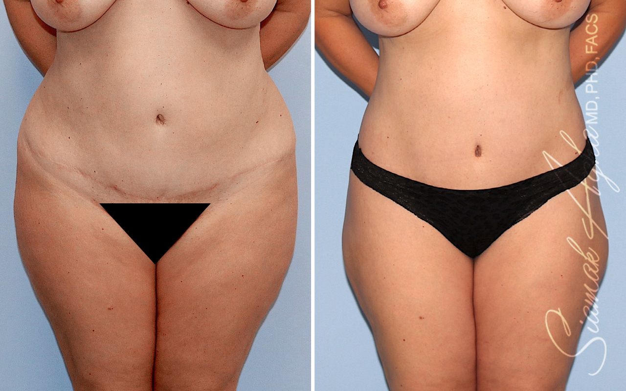 Lower Body Lift Before & After