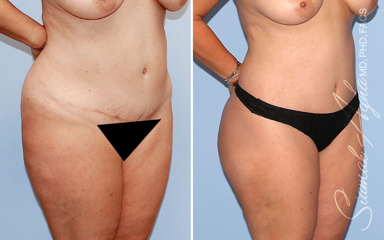 Lower Body Lift Before & After