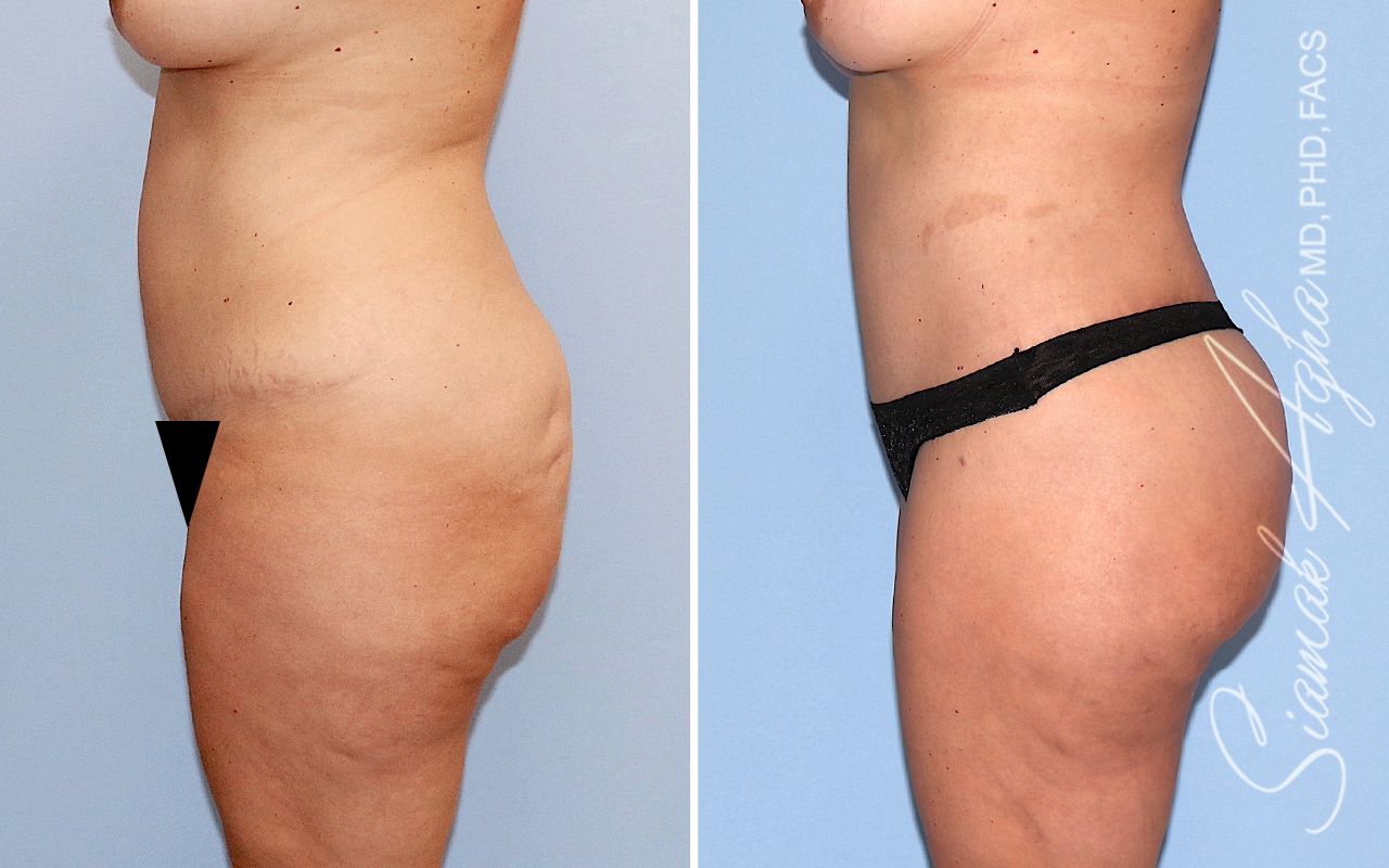 Lower Body Lift Before & After