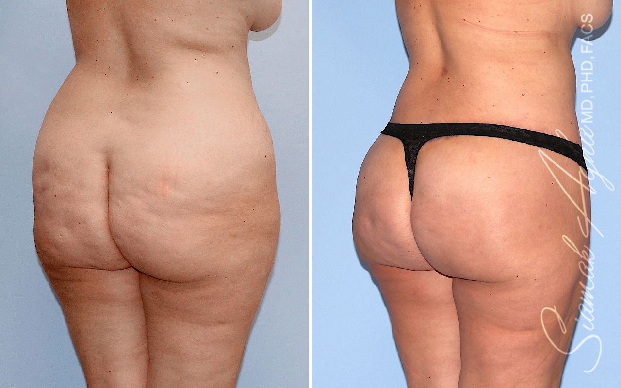 Lower Body Lift Before & After