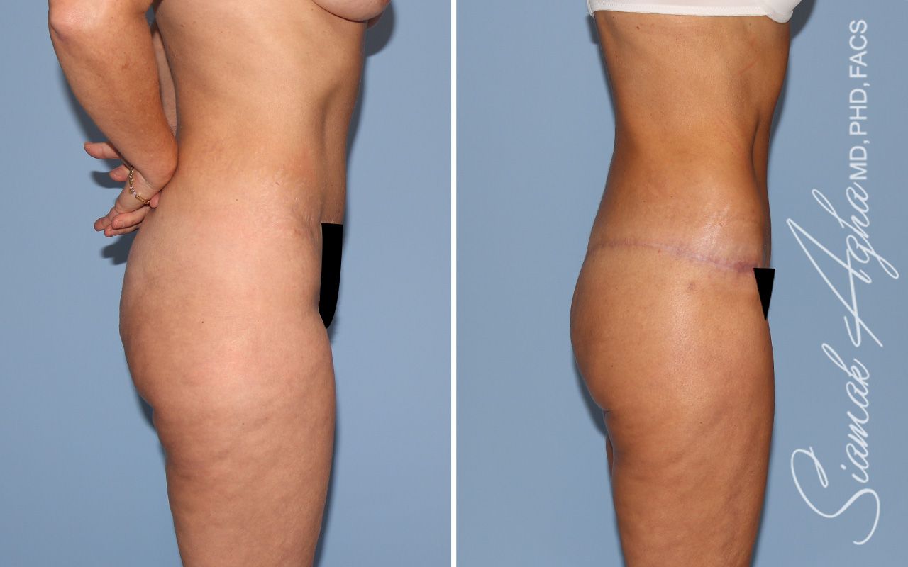 Lower Body Lift Before & After