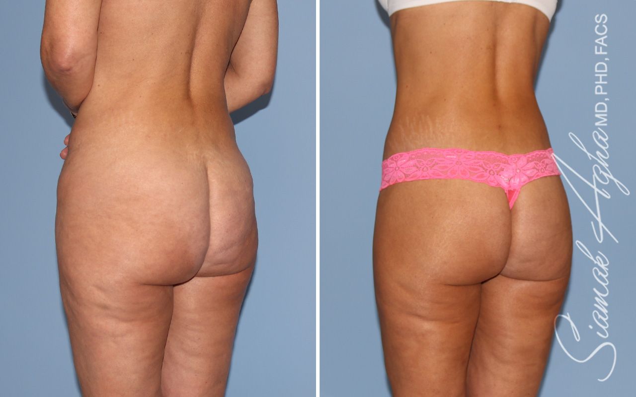 Lower Body Lift Before & After