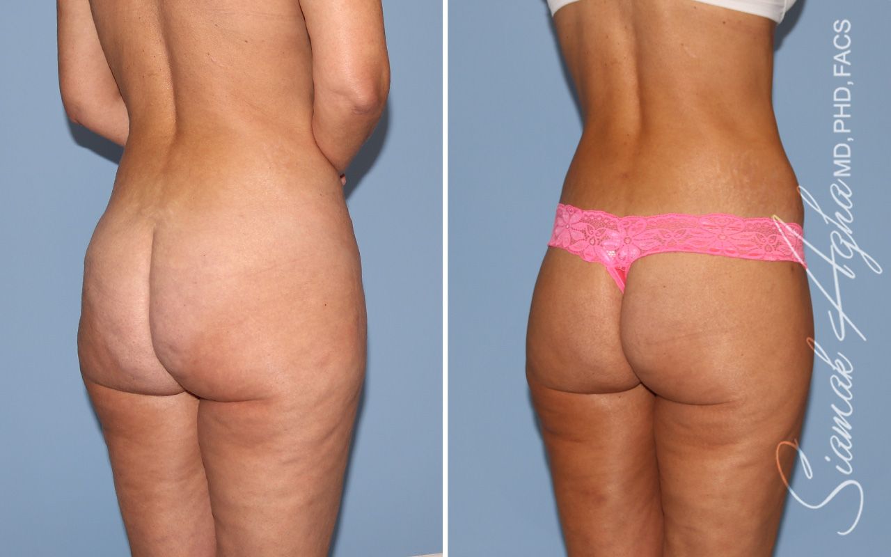 Lower Body Lift Before & After