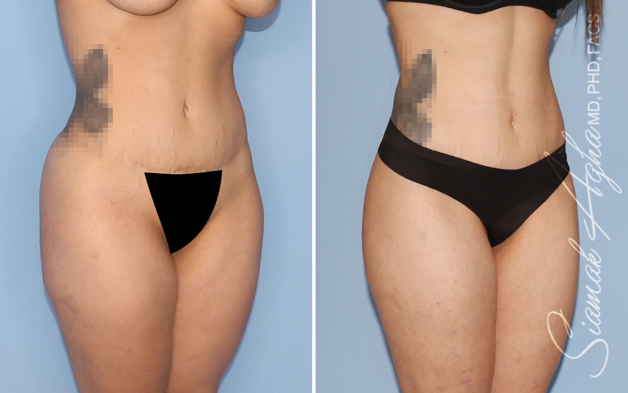 Lower Body Lift Before & After