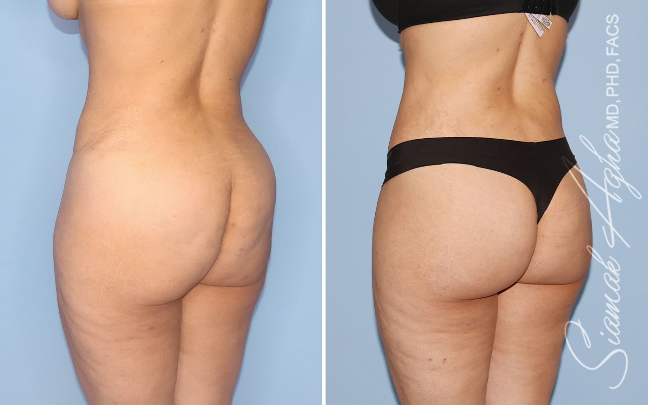 Lower Body Lift Before & After