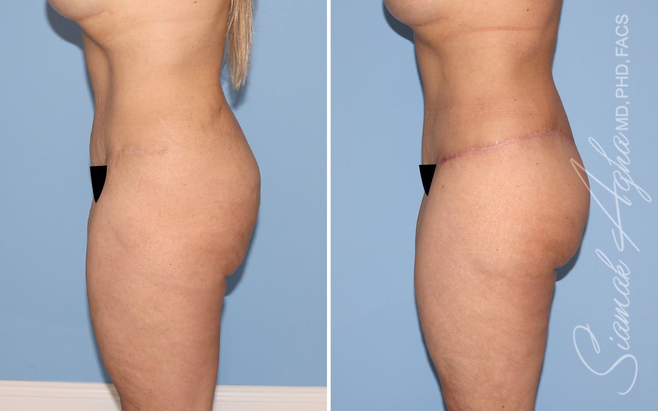 Lower Body Lift Before & After