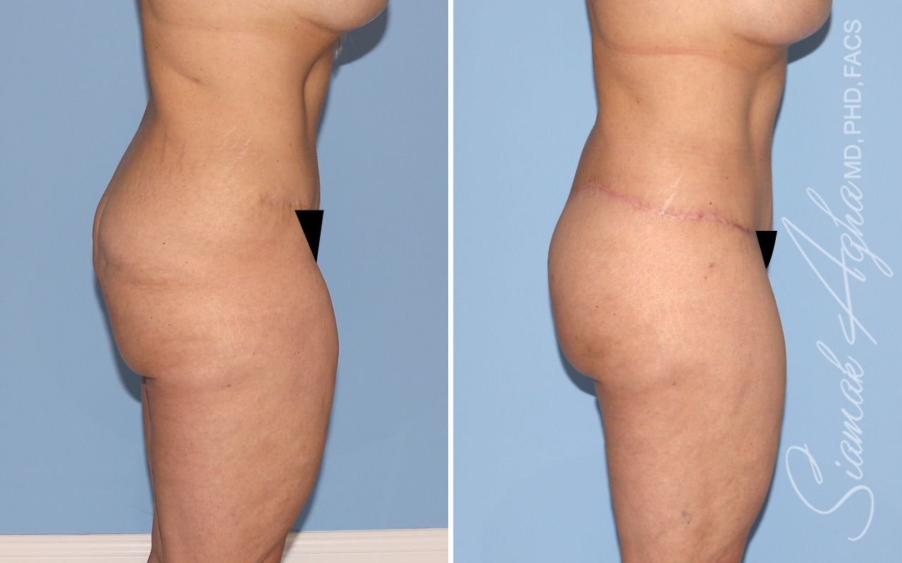 Lower Body Lift Before & After