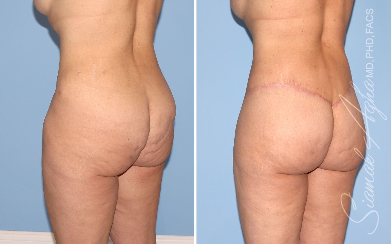 Lower Body Lift Before & After