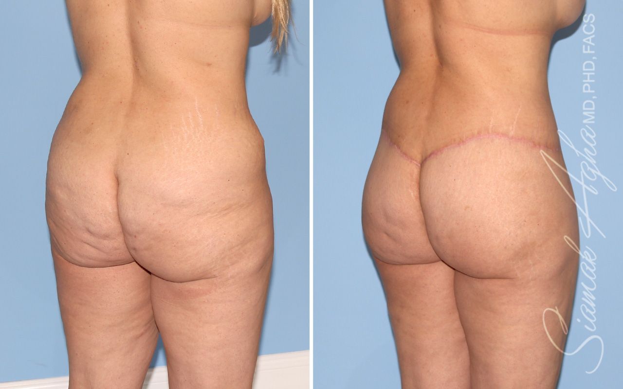 Lower Body Lift Before & After